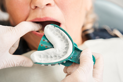 Doctor putting dental impression to client mouth